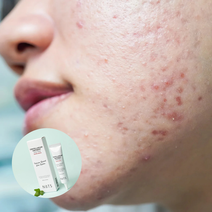 Centella is also a Game-Changer for Acne-Prone Skin